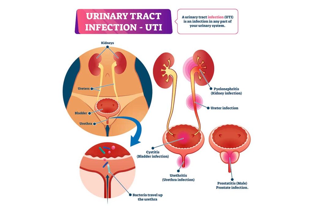 cauze infectie urinara săritul coarda și prostatita