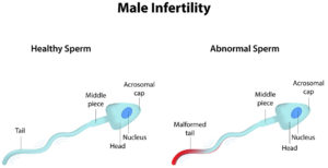 infertilitate masculina erna stoian